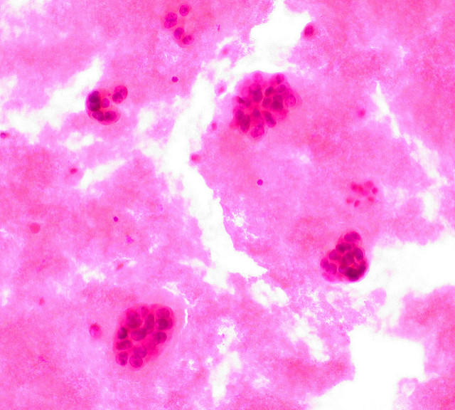 Клетка рака молочной железы. (Фото Wellcome Images / Flickr.com.)