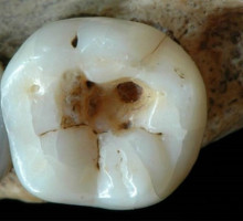 Стоматология в каменном веке